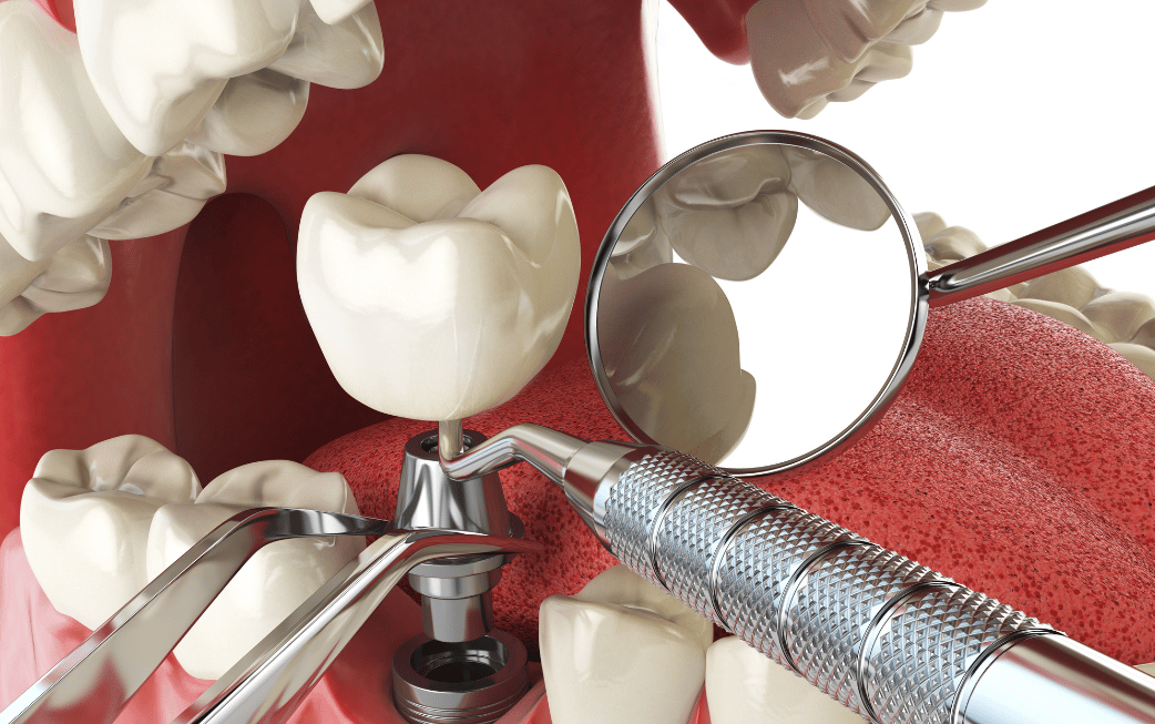 Custom dental implant solutions Edmond OK