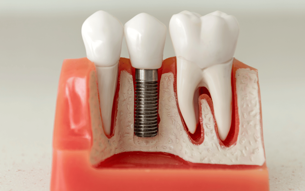 Immediate dental implant placement Edmond OK